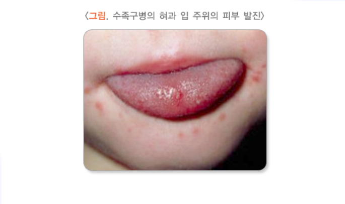 수족구 관련 증상 참고 이미지 2