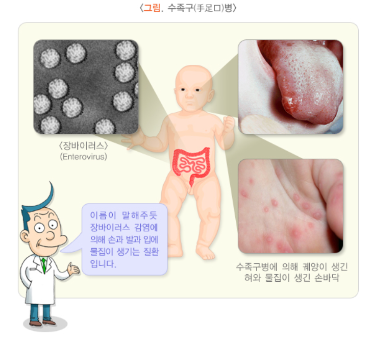 수족구 관련 증상 참고 이미지 1